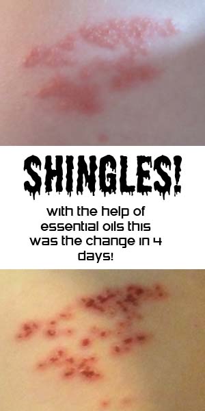 Shingles- Overcoming With The Help Of Essential Oils! * Shannon's Grotto